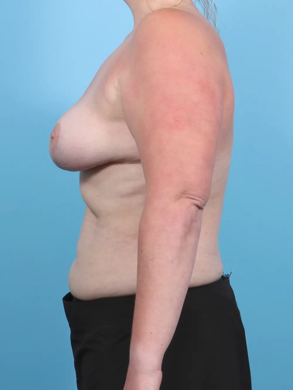 Breast Lift/Reduction w/o Implants Patient Photo - Case 47871 - after view-2