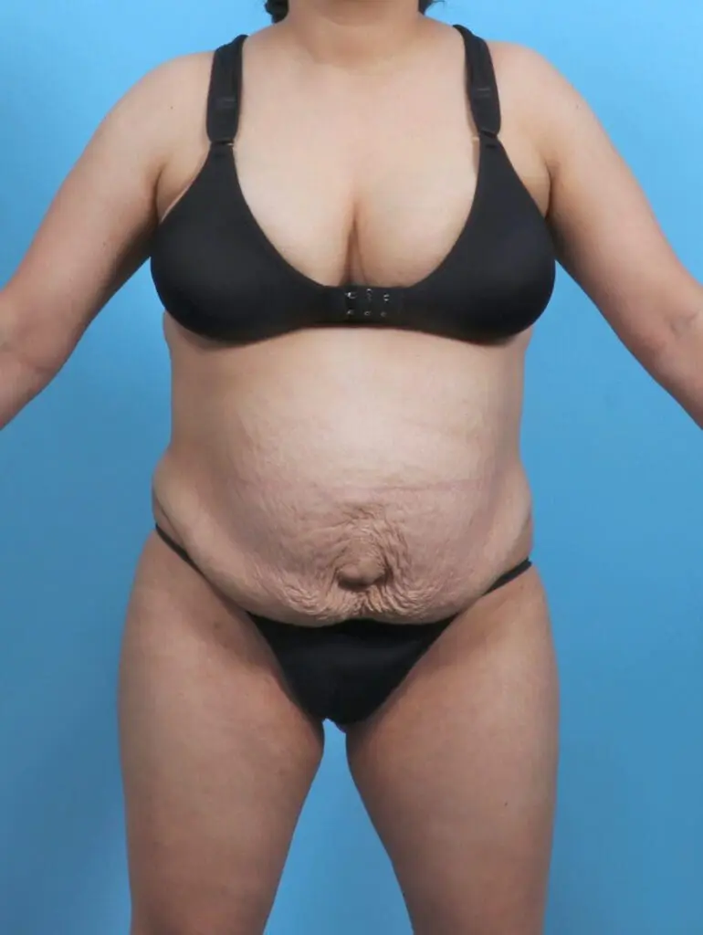 Tummy Tuck - Case 47879 - Before