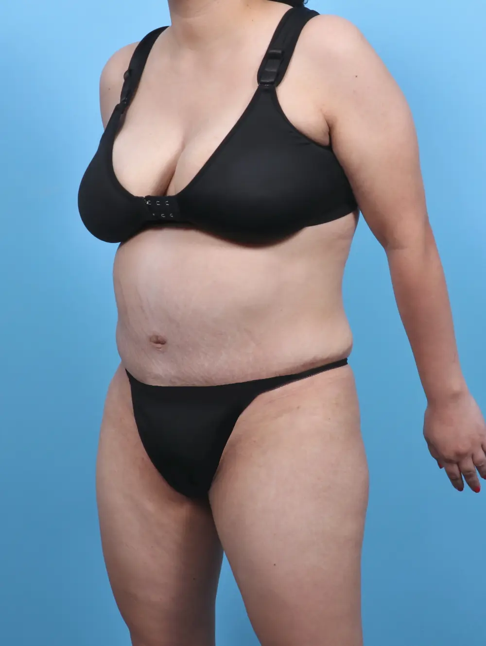 Tummy Tuck Patient Photo - Case 47879 - after view-1