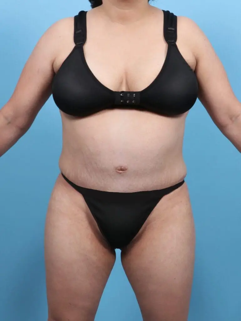 Tummy Tuck - Case 47879 - After