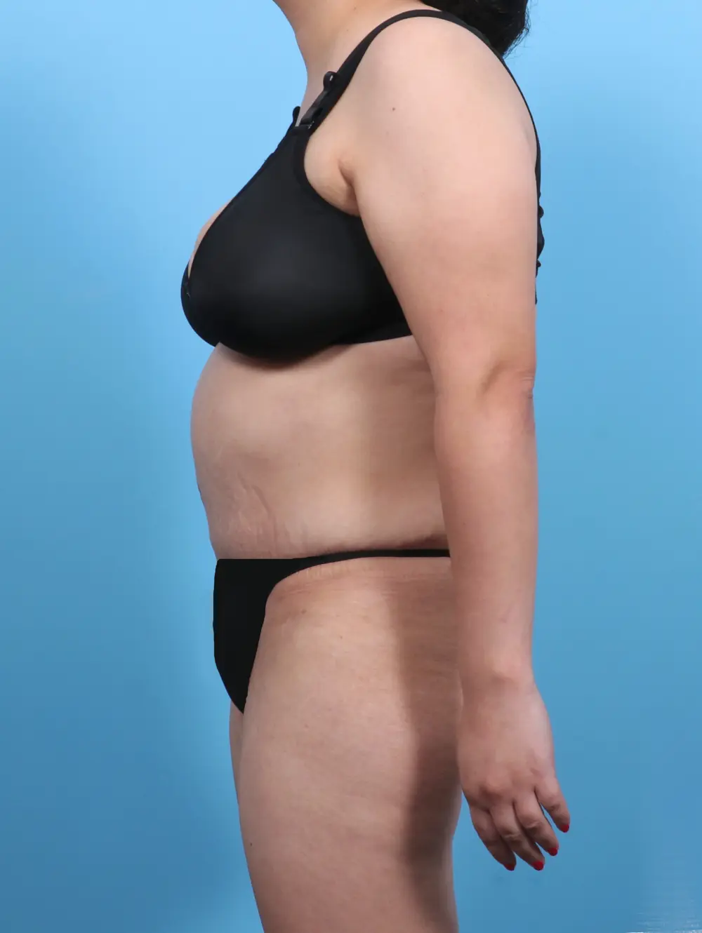 Tummy Tuck Patient Photo - Case 47879 - after view-2