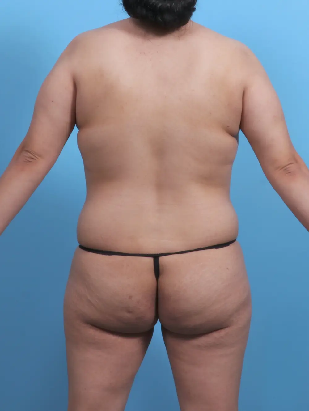 Tummy Tuck Patient Photo - Case 47879 - before view-3