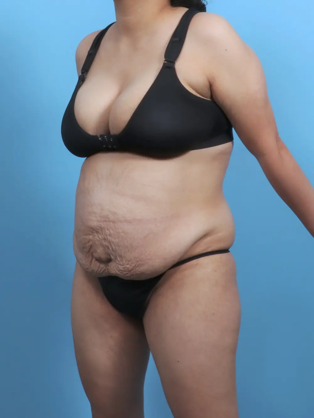 Tummy Tuck Patient Photo - Case 47879 - before view-1