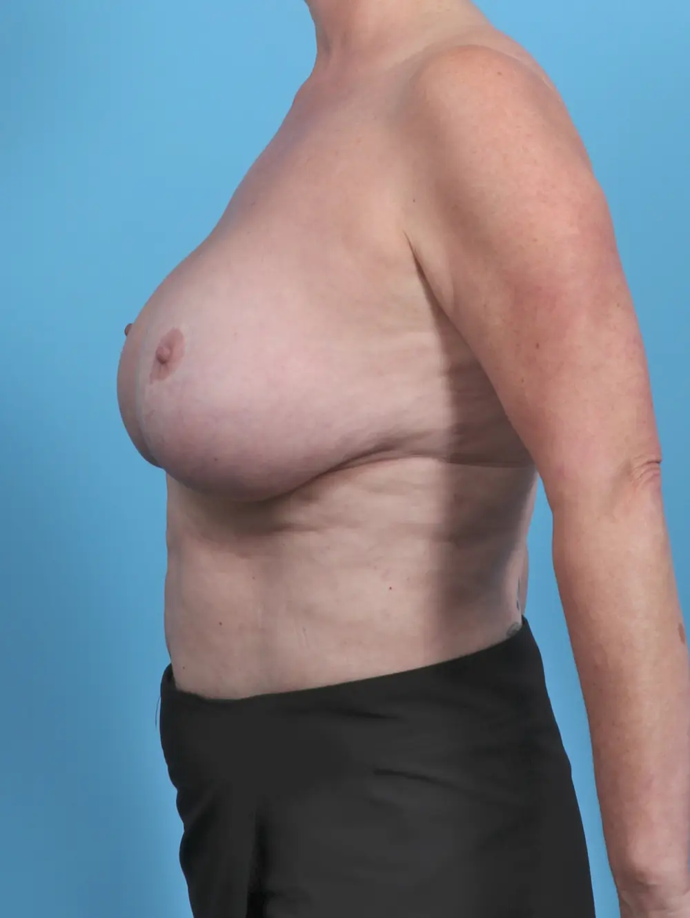 Breast Implant Revision Patient Photo - Case 47897 - before view-2