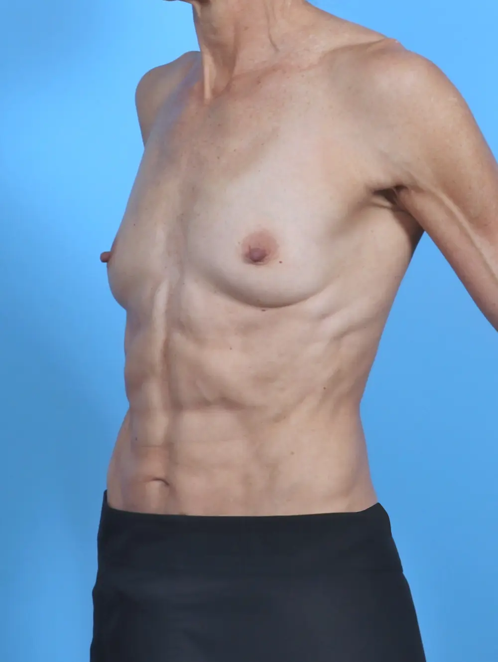 Breast Augmentation Patient Photo - Case 47971 - before view-1