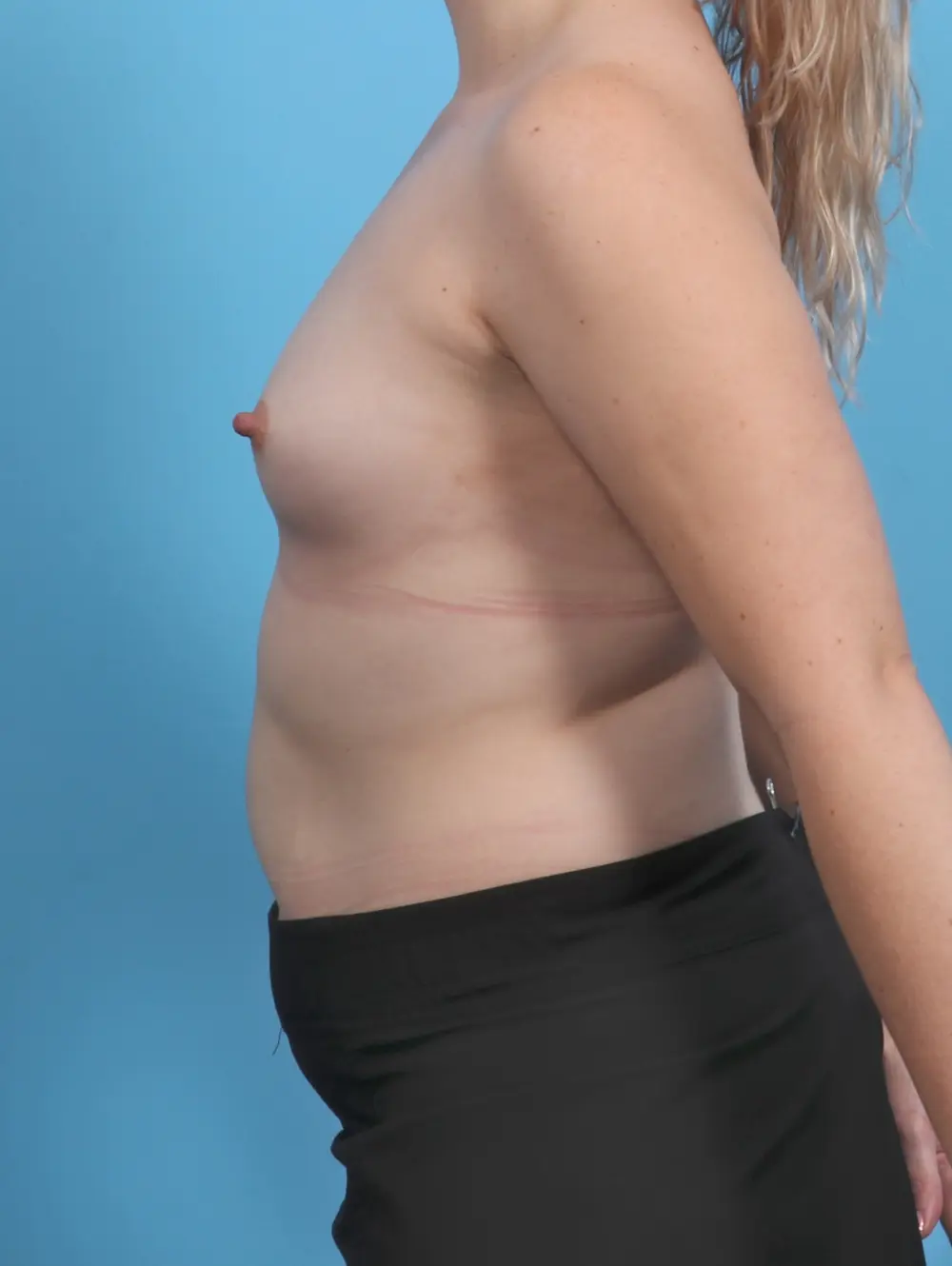 Breast Augmentation Patient Photo - Case 48060 - before view-2