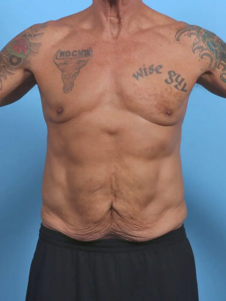 Male Tummy Tuck - Case 48068 - Before