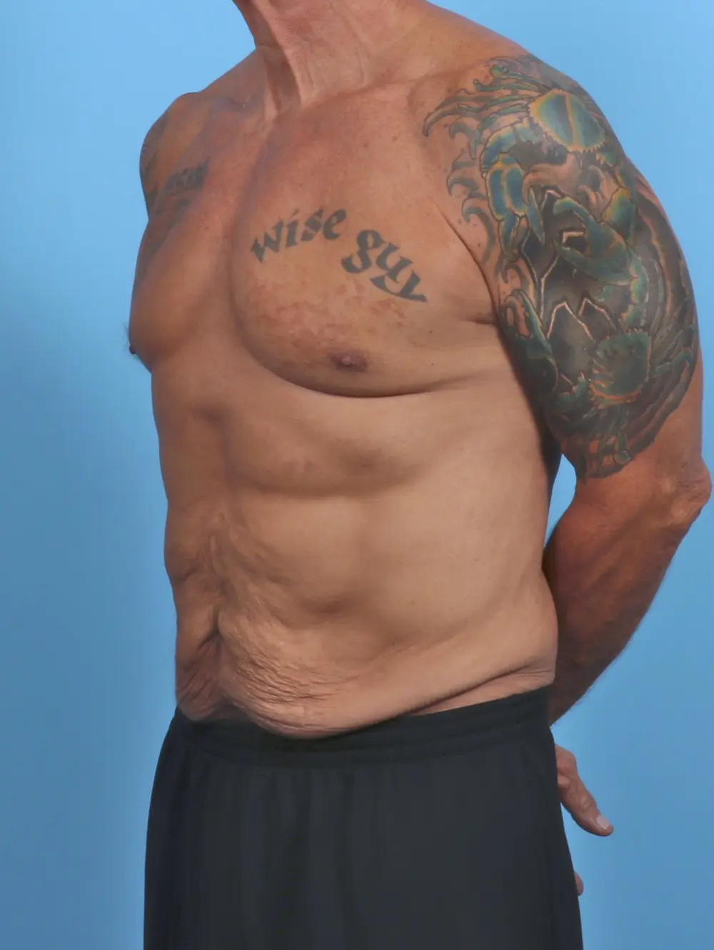 Male Tummy Tuck Patient Photo - Case 48068 - before view-1