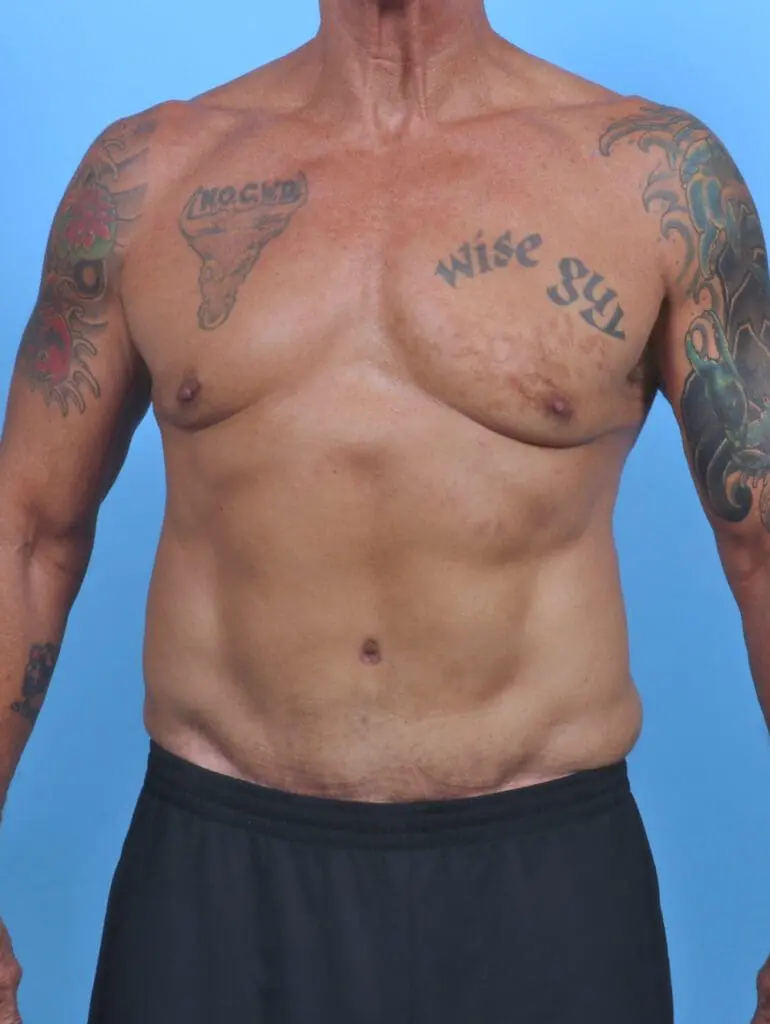 Male Tummy Tuck - Case 48068 - After