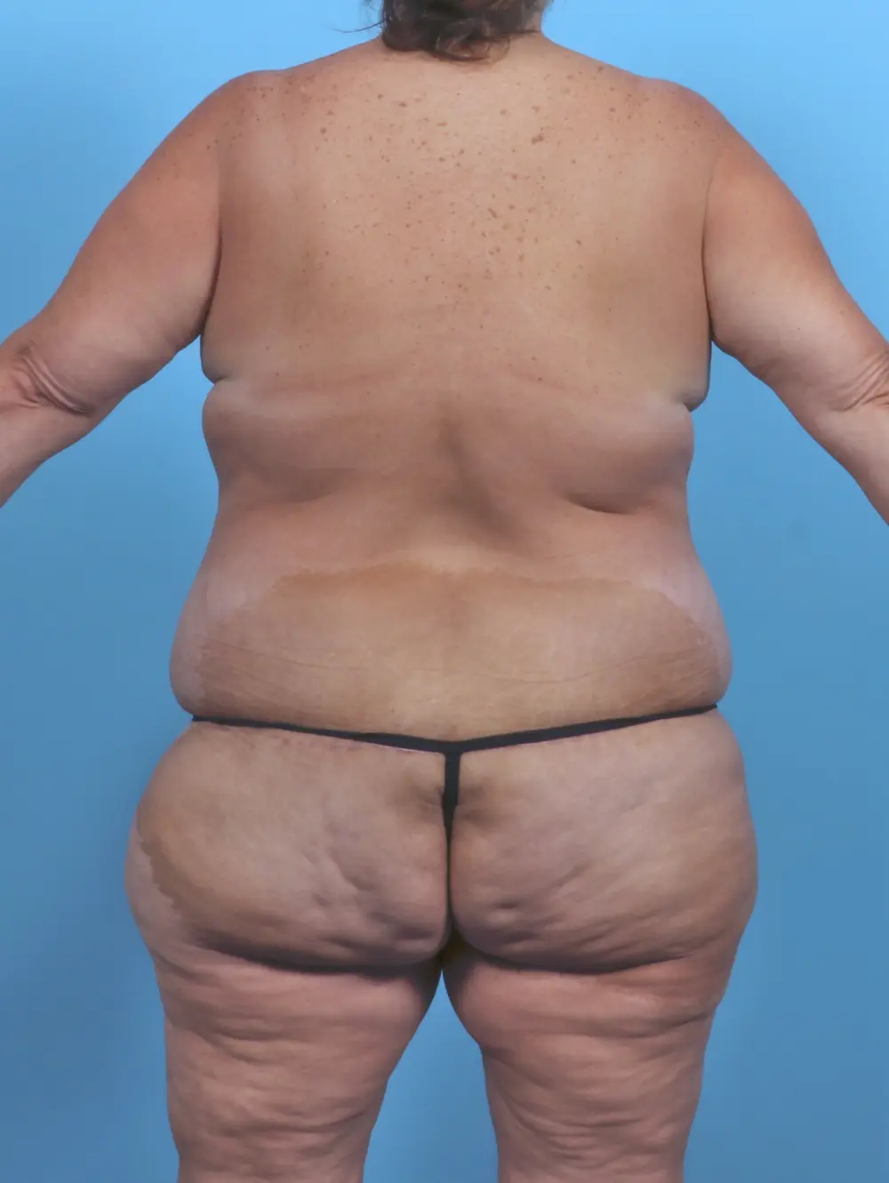 After Weight Loss Patient Photo - Case 48076 - after view-3