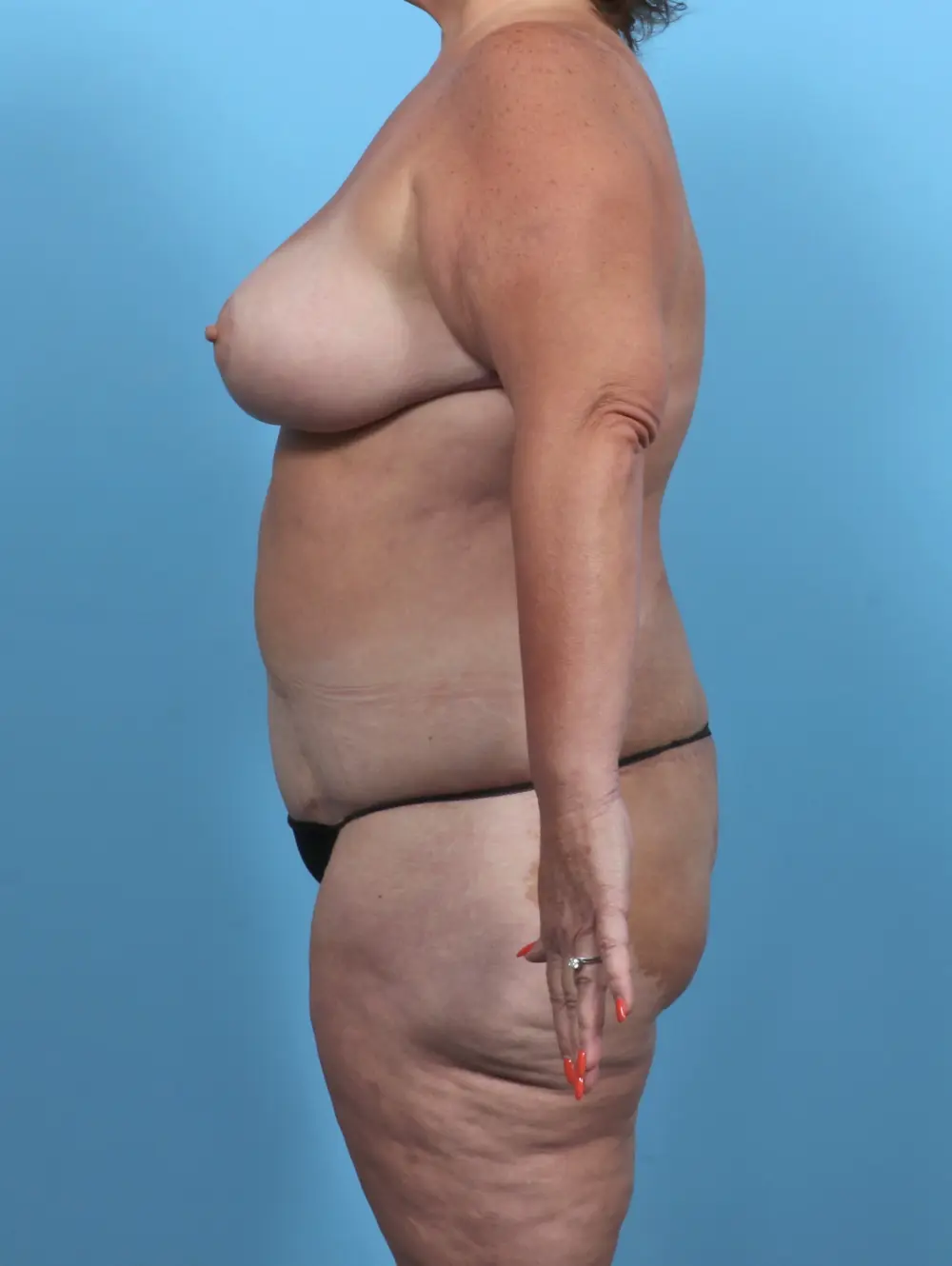 After Weight Loss Patient Photo - Case 48076 - after view-2