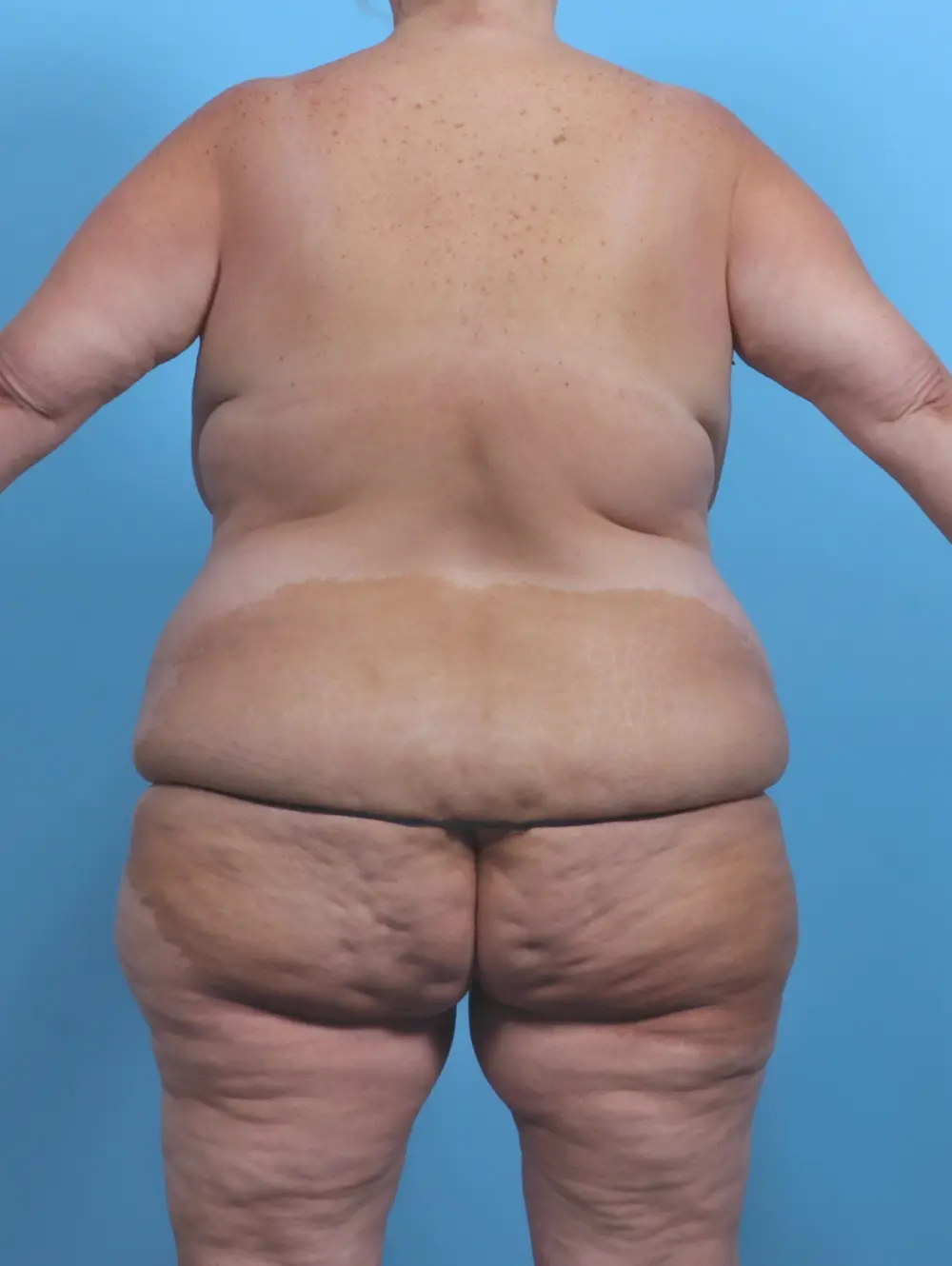 After Weight Loss Patient Photo - Case 48076 - before view-3