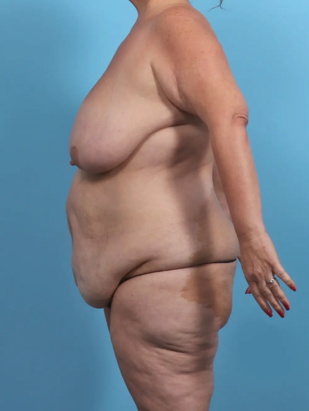 After Weight Loss Patient Photo - Case 48076 - before view-2