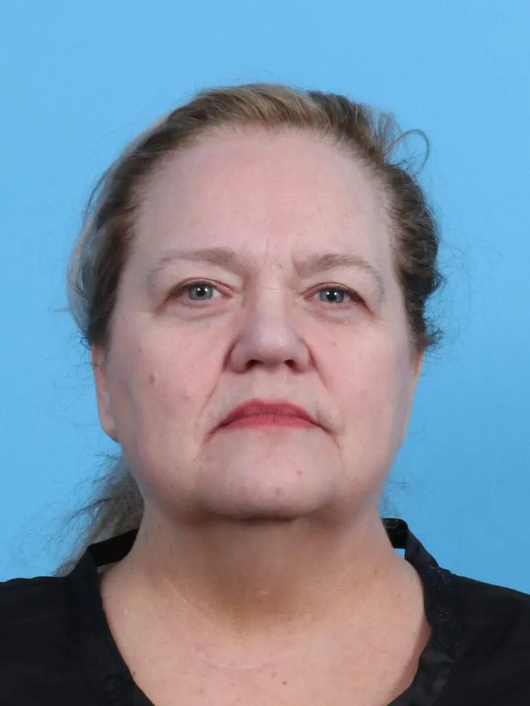 Facelift / Neck Lift - Case 48086 - Before