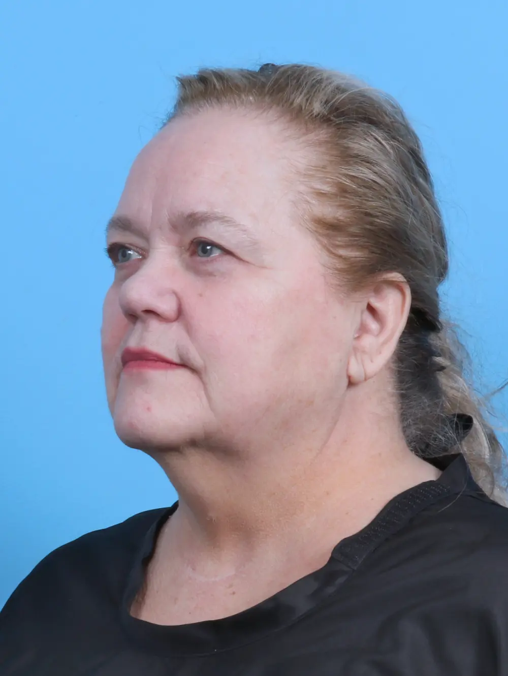 Facelift / Neck Lift Patient Photo - Case 48086 - before view-1