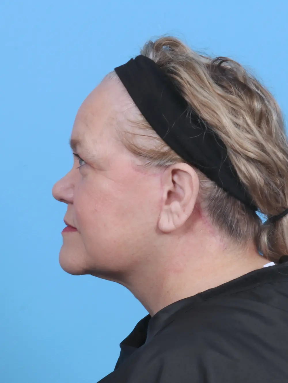 Facelift / Neck Lift Patient Photo - Case 48086 - after view-2