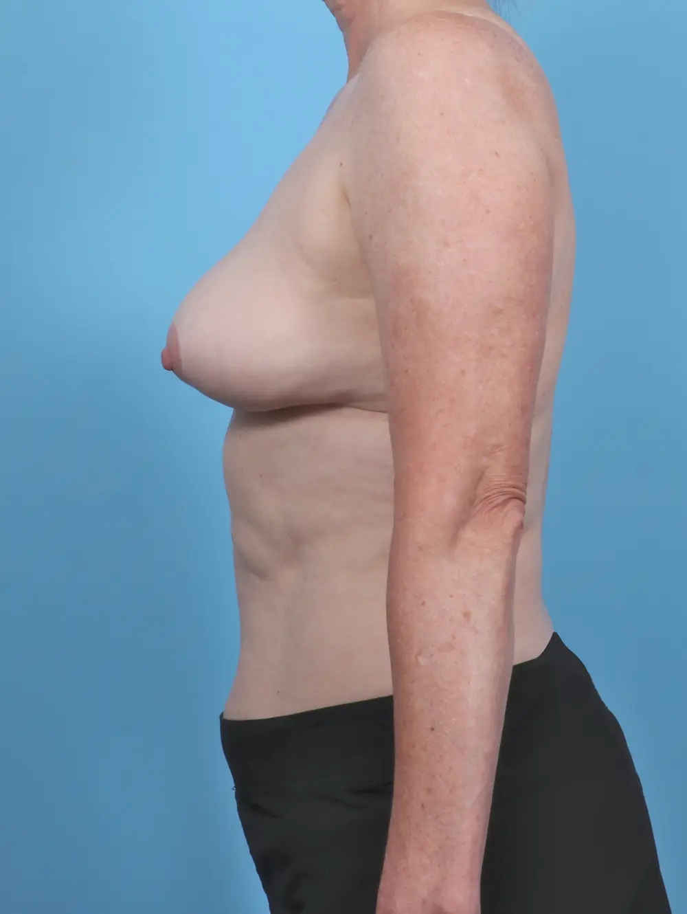 Breast Implant Removal Patient Photo - Case 48102 - after view-2