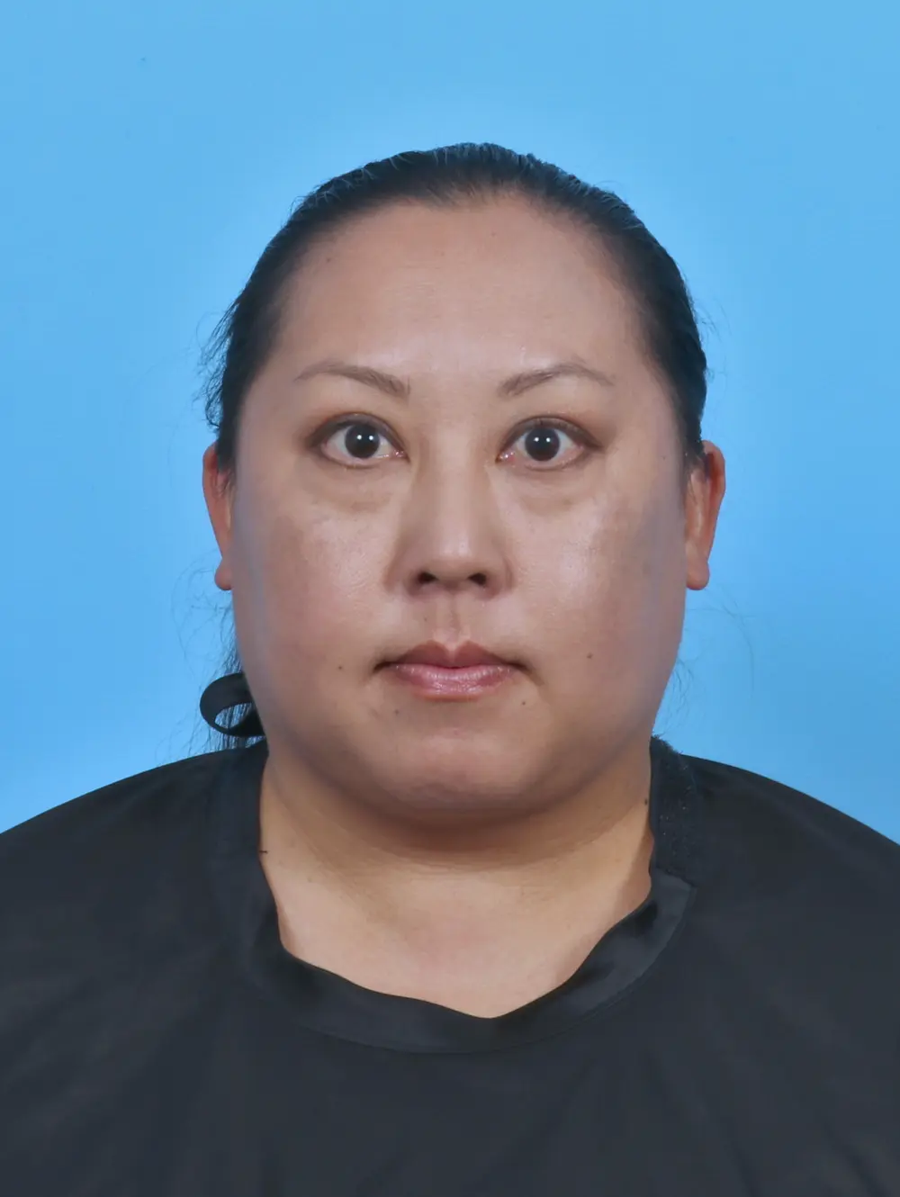 Liposuction Patient Photo - Case 48110 - after view-2