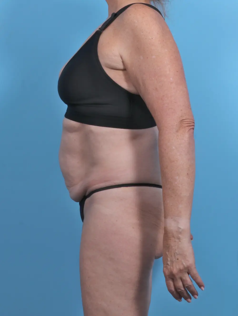 Tummy Tuck Patient Photo - Case 48126 - before view-2