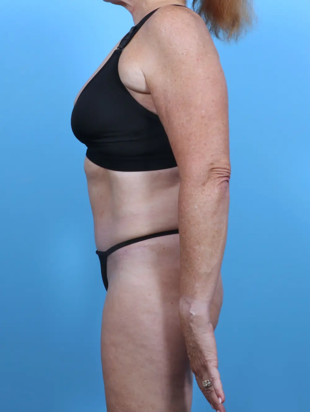 Tummy Tuck Patient Photo - Case 48126 - after view-2