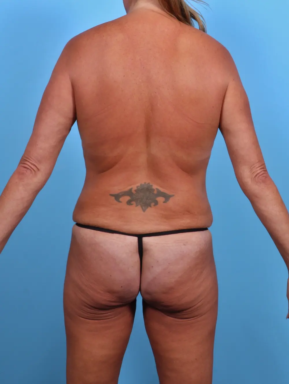 Breast Lift/Reduction with Implants Patient Photo - Case 48142 - after view-3