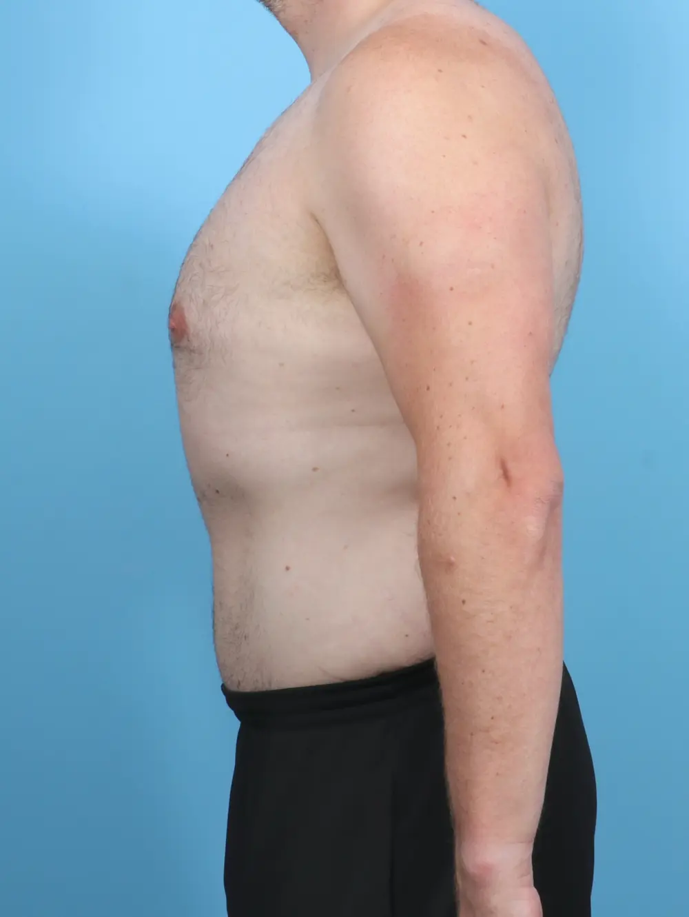 Male Tummy Tuck Patient Photo - Case 48162 - after view-2