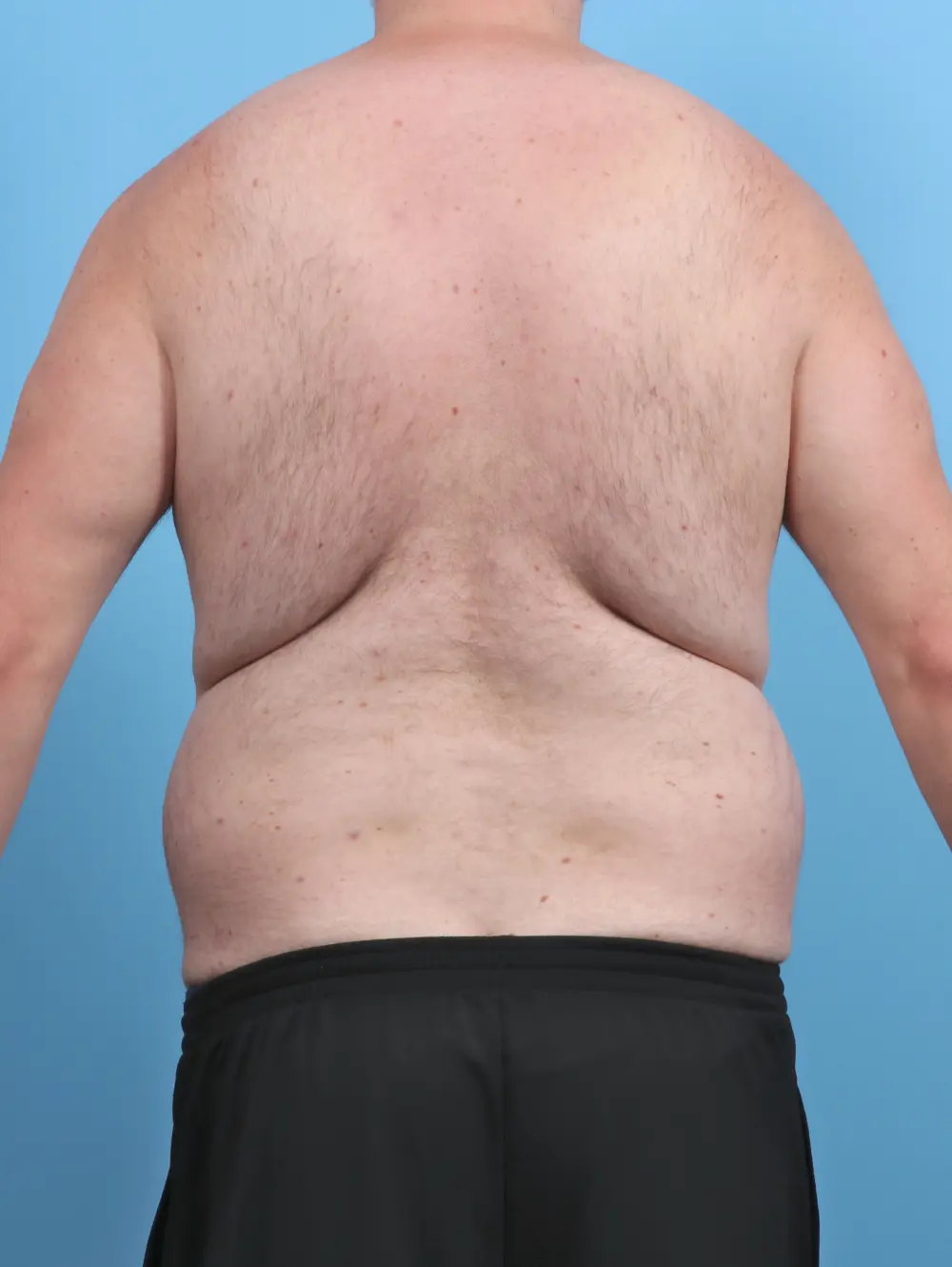 Male Tummy Tuck Patient Photo - Case 48162 - before view-3