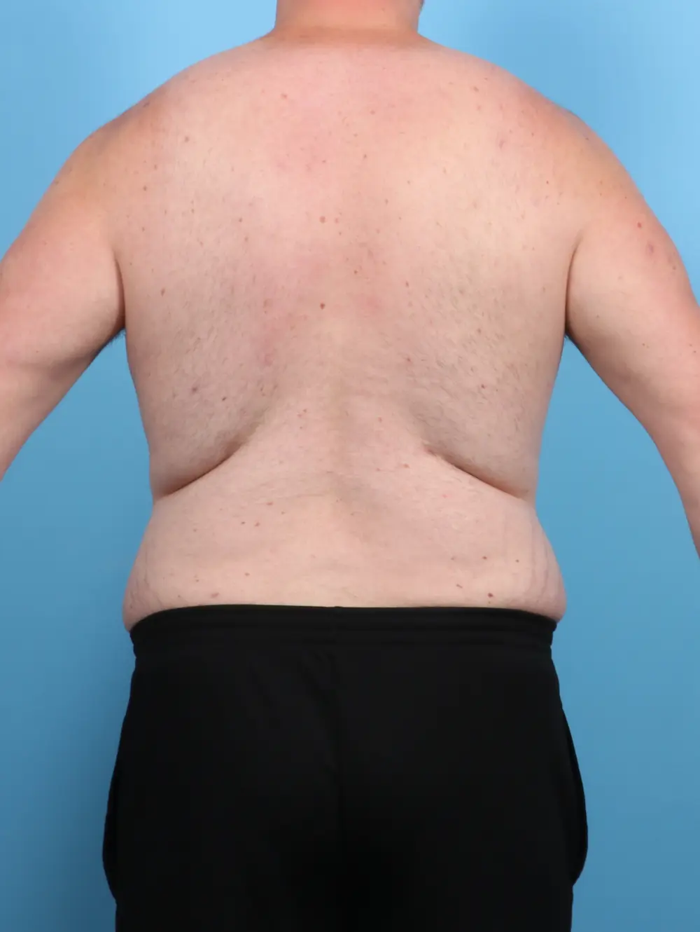 Male Tummy Tuck Patient Photo - Case 48162 - after view-3