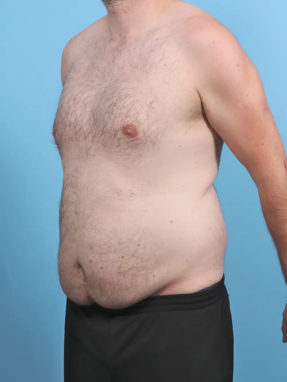 Male Tummy Tuck Patient Photo - Case 48162 - before view-1