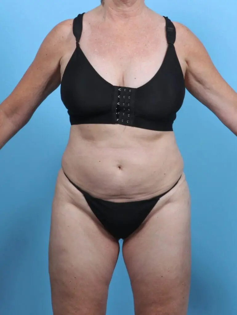 Liposuction - Case 48188 - After