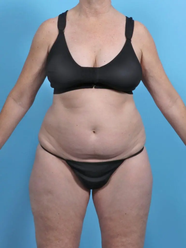 Liposuction - Case 48188 - Before