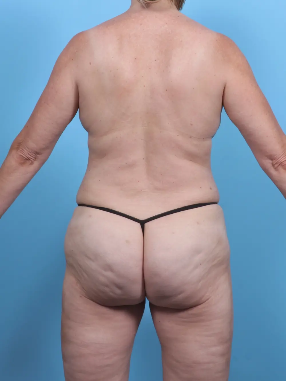 Liposuction Patient Photo - Case 48188 - after view-3