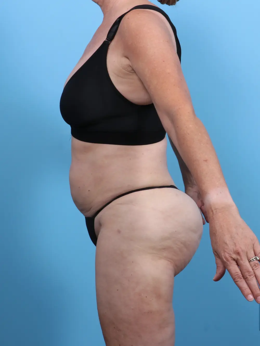 Liposuction Patient Photo - Case 48188 - after view-2