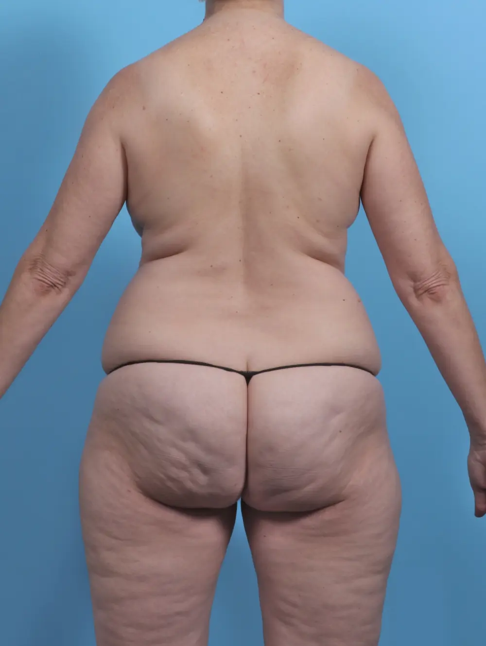 Liposuction Patient Photo - Case 48188 - before view-3