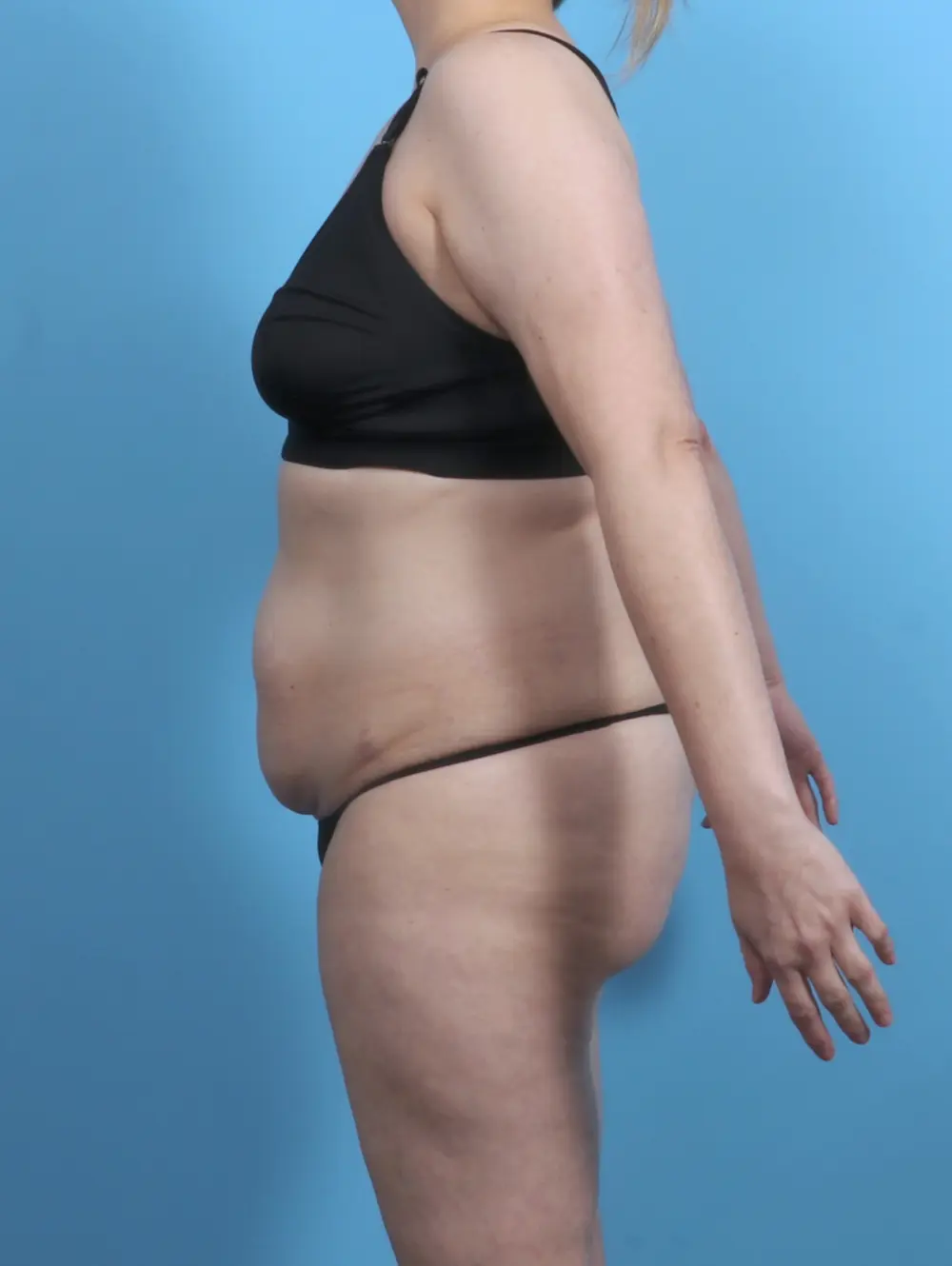 Tummy Tuck Patient Photo - Case 48214 - before view-2