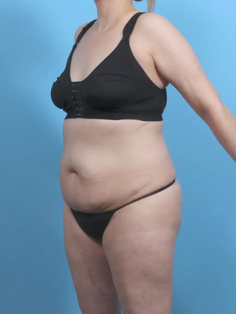 Tummy Tuck Patient Photo - Case 48214 - before view-1