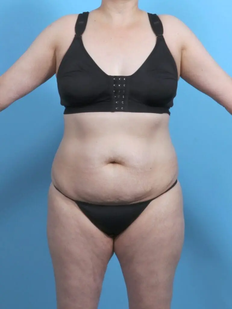 Tummy Tuck - Case 48214 - Before