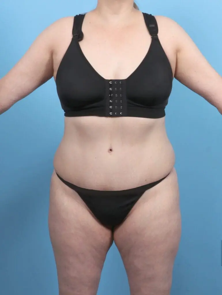 Tummy Tuck - Case 48214 - After