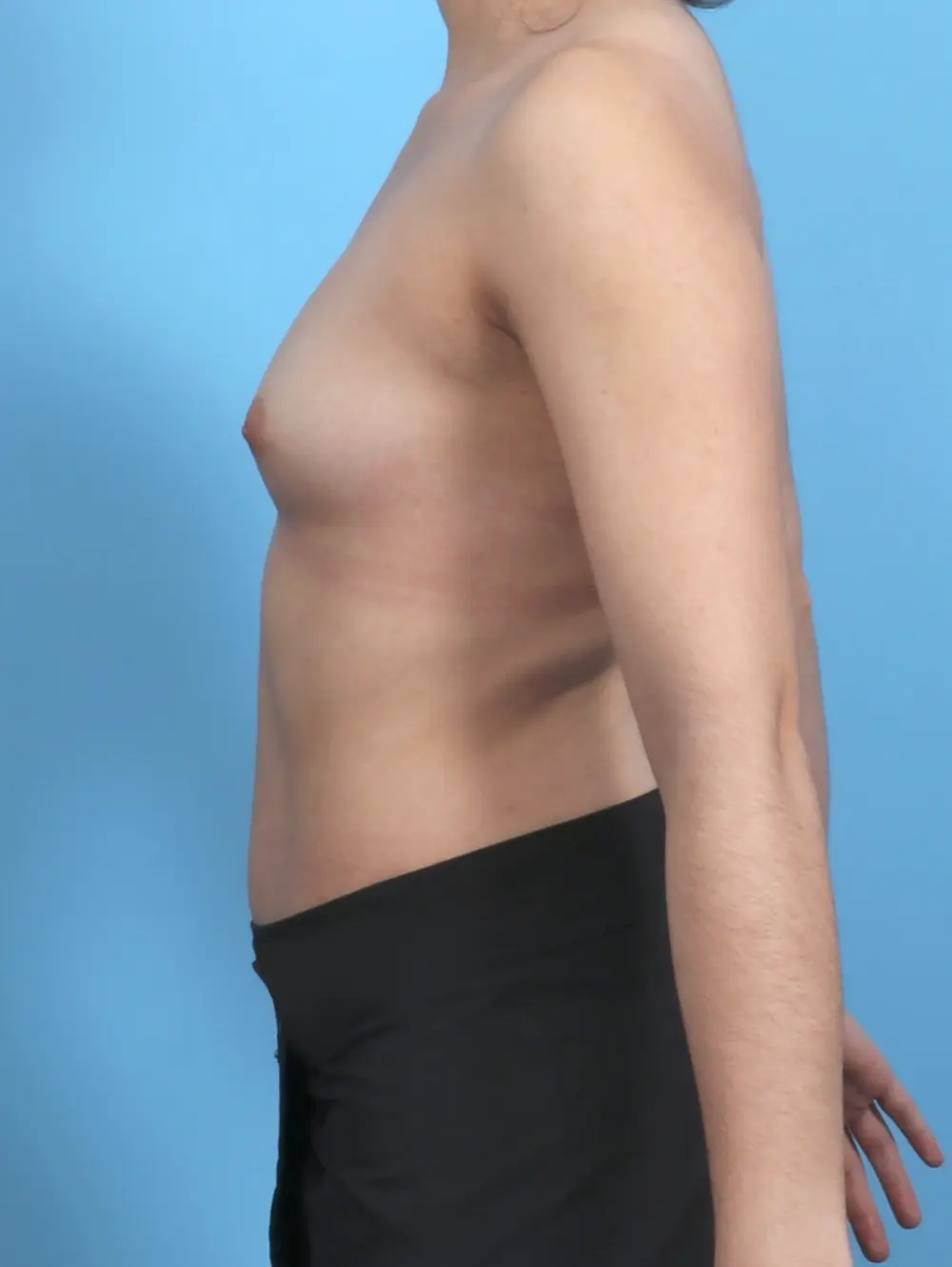 Breast Augmentation Patient Photo - Case 48223 - before view-2