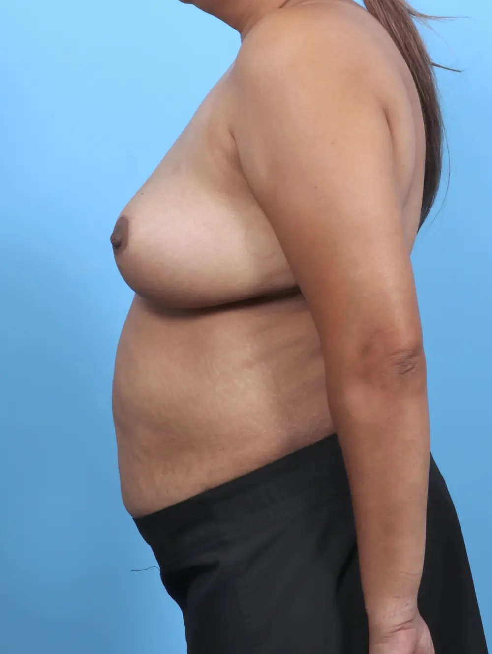 Breast Lift/Reduction w/o Implants Patient Photo - Case 48231 - after view-2