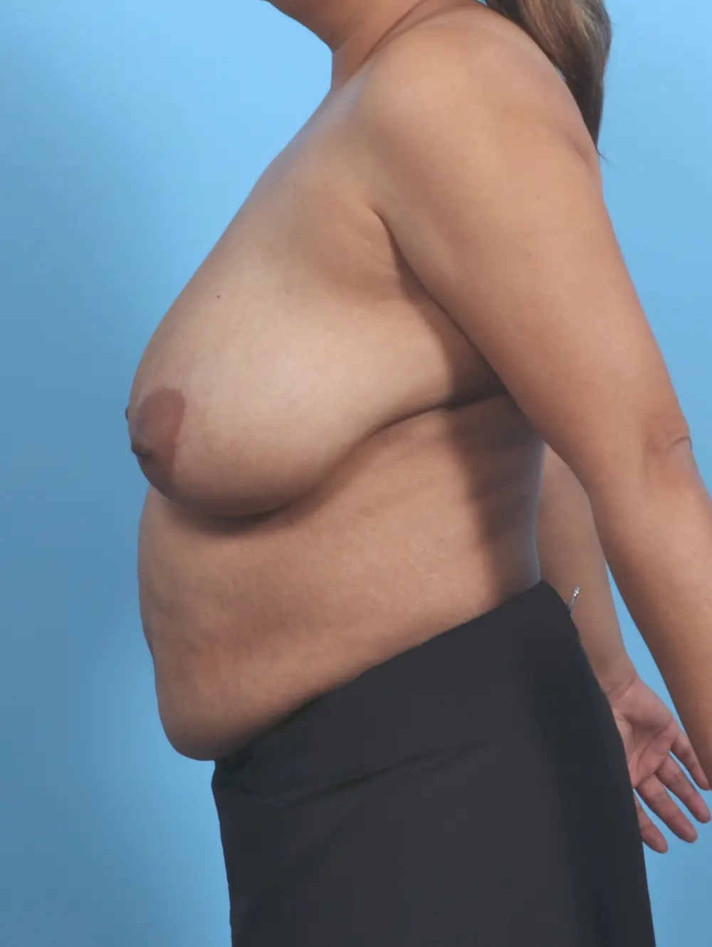 Breast Lift/Reduction w/o Implants Patient Photo - Case 48231 - before view-2