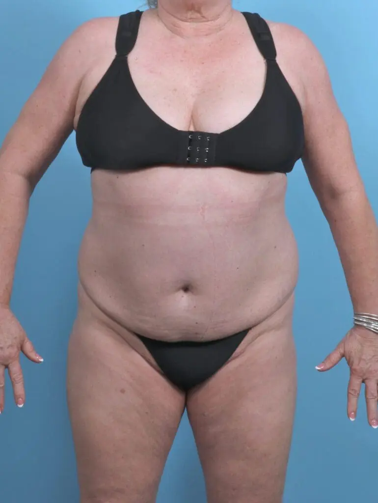 Tummy Tuck - Case 48239 - Before