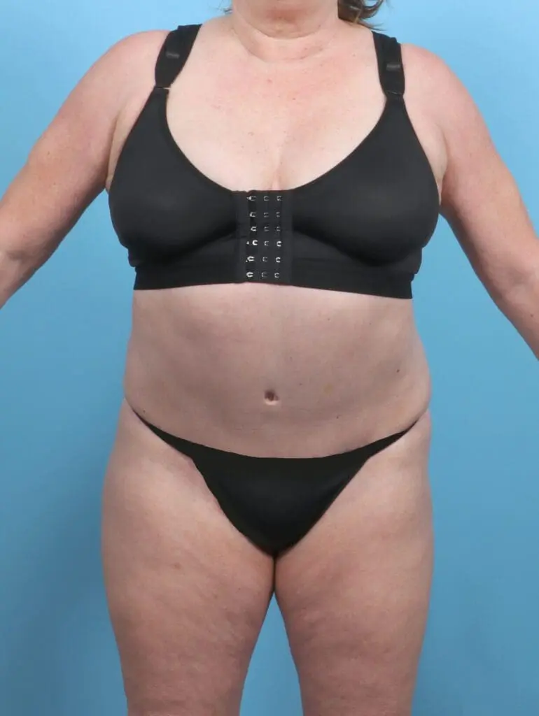 Tummy Tuck - Case 48239 - After