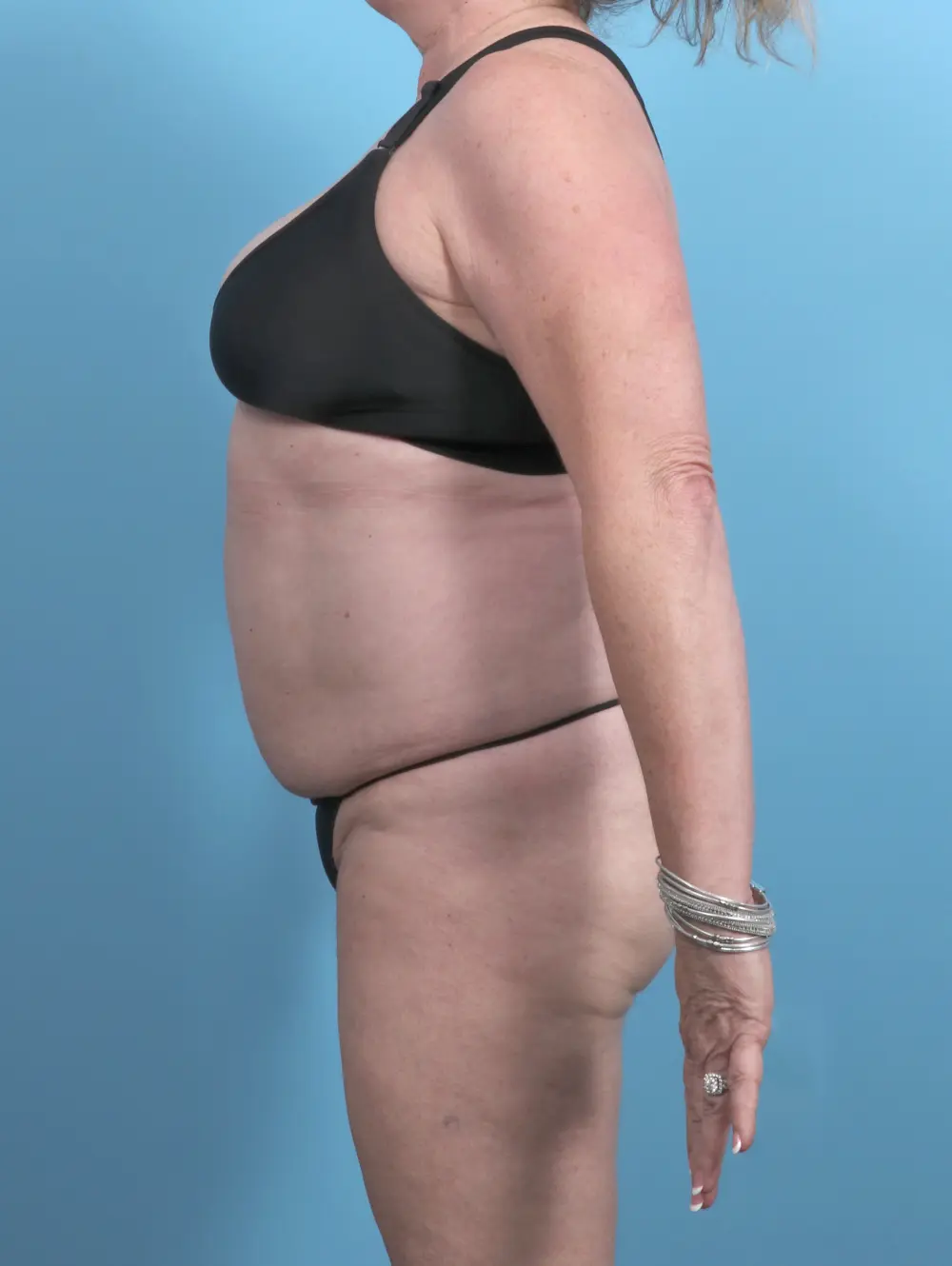 Tummy Tuck Patient Photo - Case 48239 - before view-2