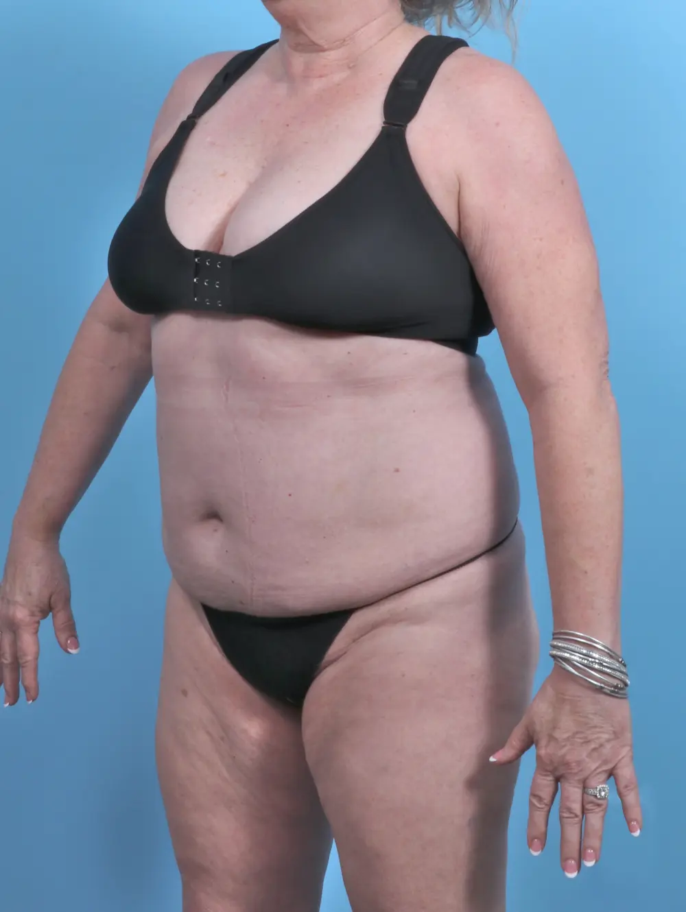 Tummy Tuck Patient Photo - Case 48239 - before view-1