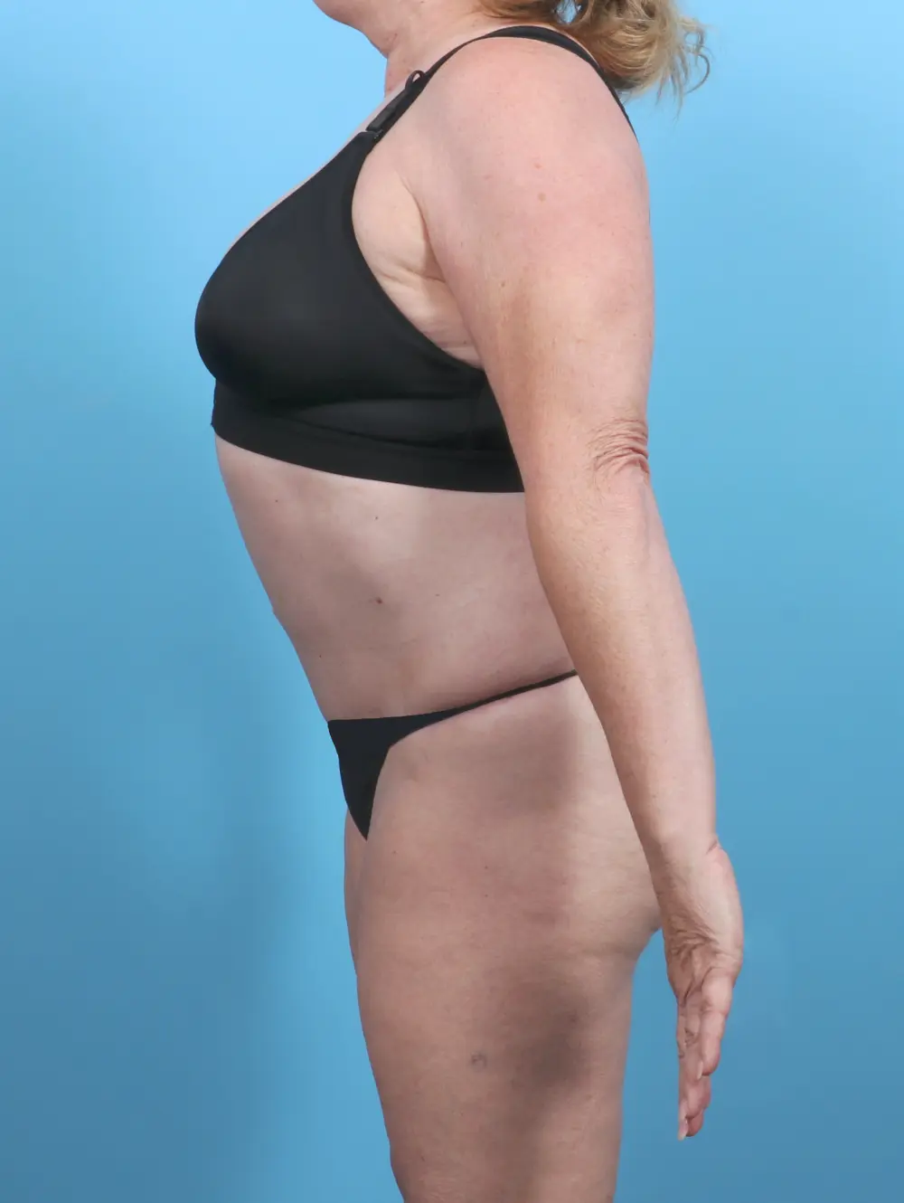 Tummy Tuck Patient Photo - Case 48239 - after view-2