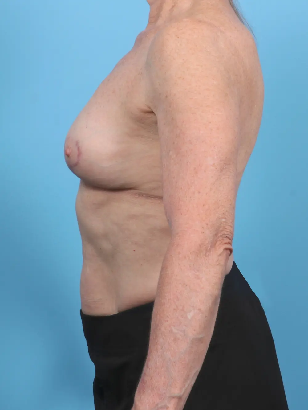 Breast Implant Removal Patient Photo - Case 48249 - after view-2