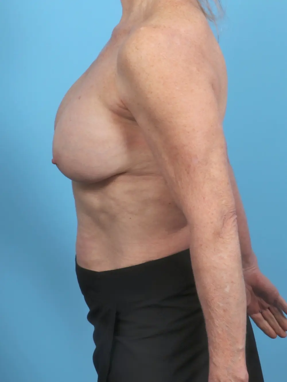 Breast Implant Removal Patient Photo - Case 48249 - before view-2