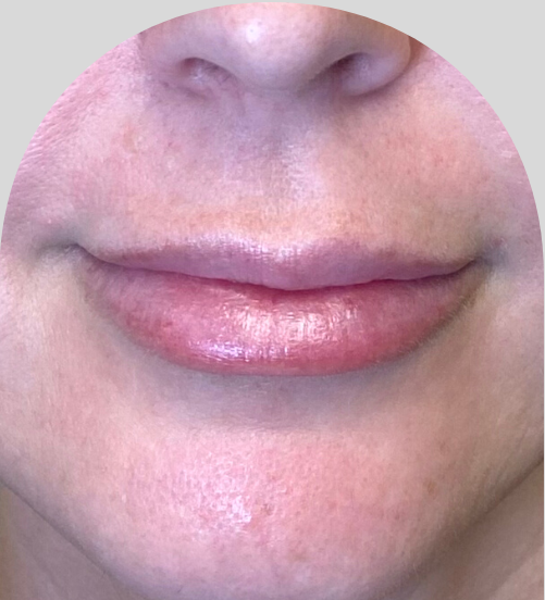 Lip Fillers - Case 48313 - Before