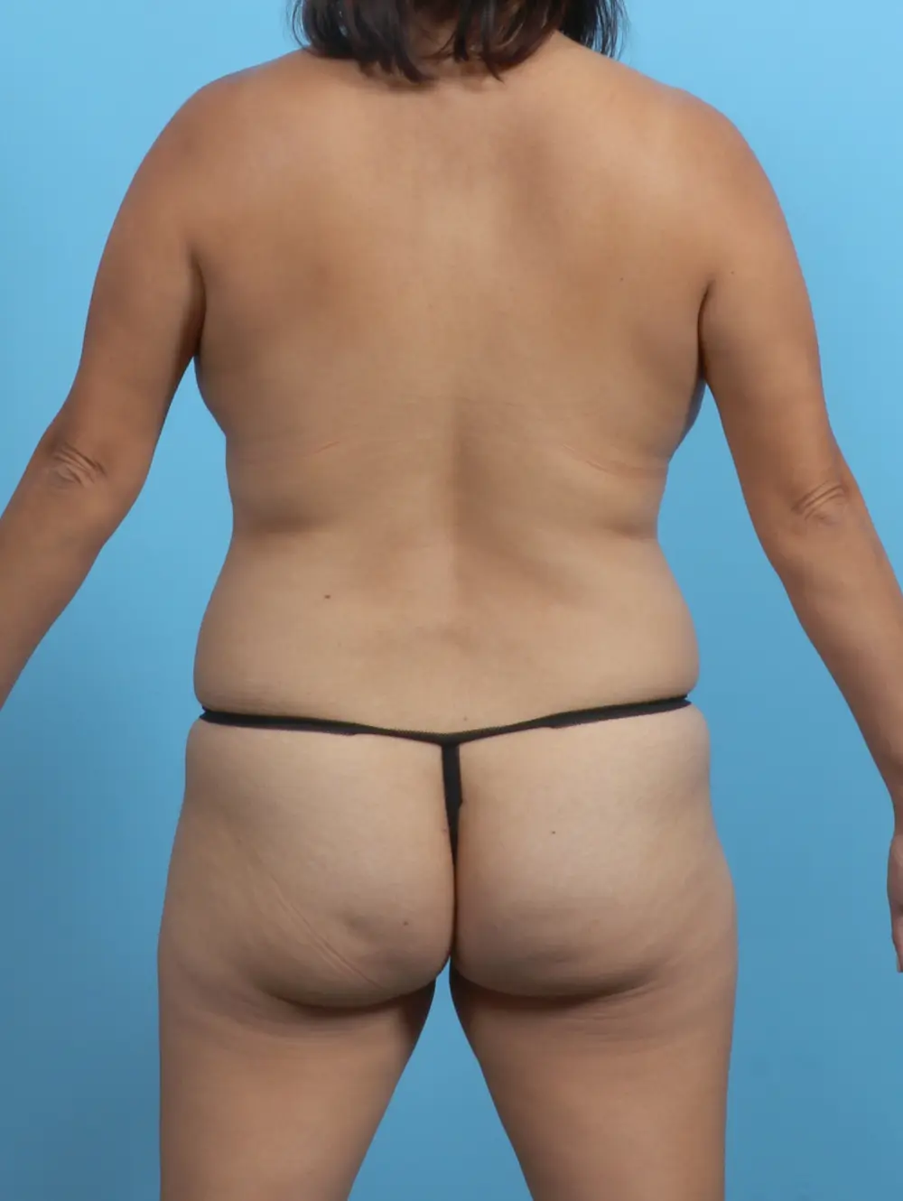 Breast Lift/Reduction w/o Implants Patient Photo - Case 50502 - before view-3